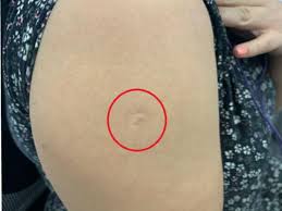 La razón por la que las personas en México tienen una cicatriz en el brazo