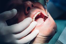Los dentistas enfrentan una epidemia de dientes rotos: ¿qué está pasando?