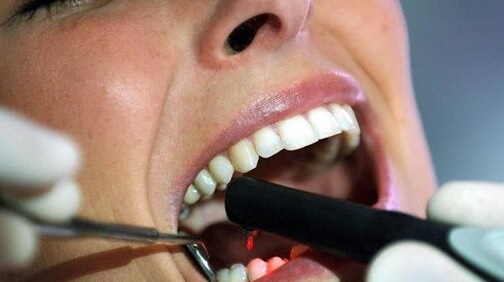 Caída de dientes, sin dolor y sin sangre, posible secuela del Covid-19