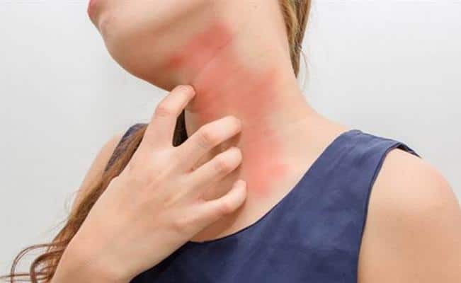 Alergia por estrés: síntomas, tratamiento y todo lo que debes saber