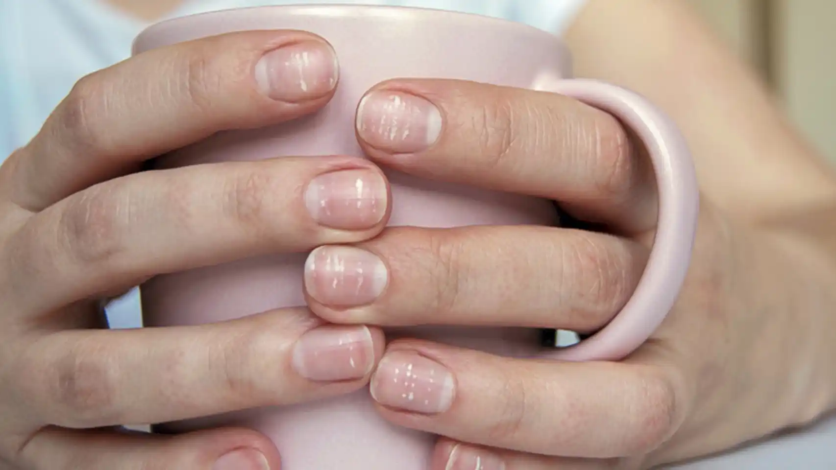 ¿Qué indican las estrías, rayas o cambio de color en las uñas?